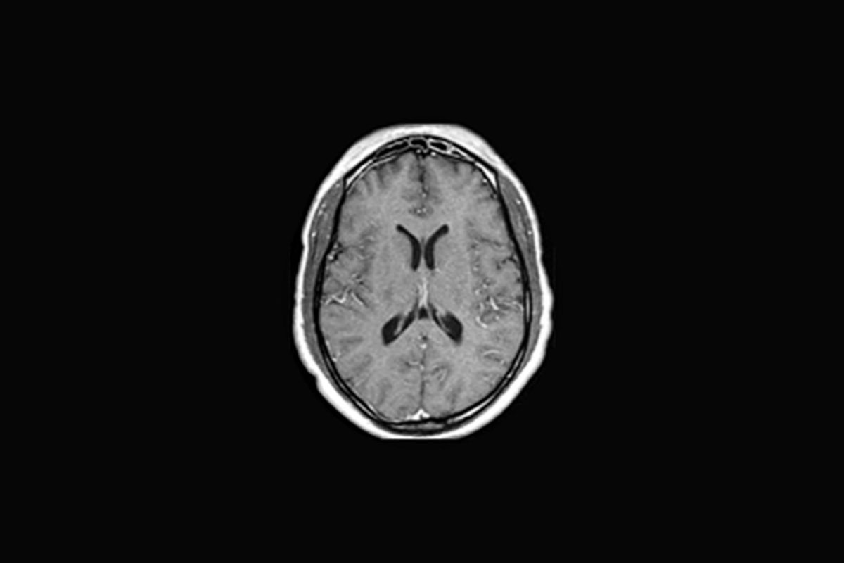 CSF Shunts Neurosurgery Kids Fund