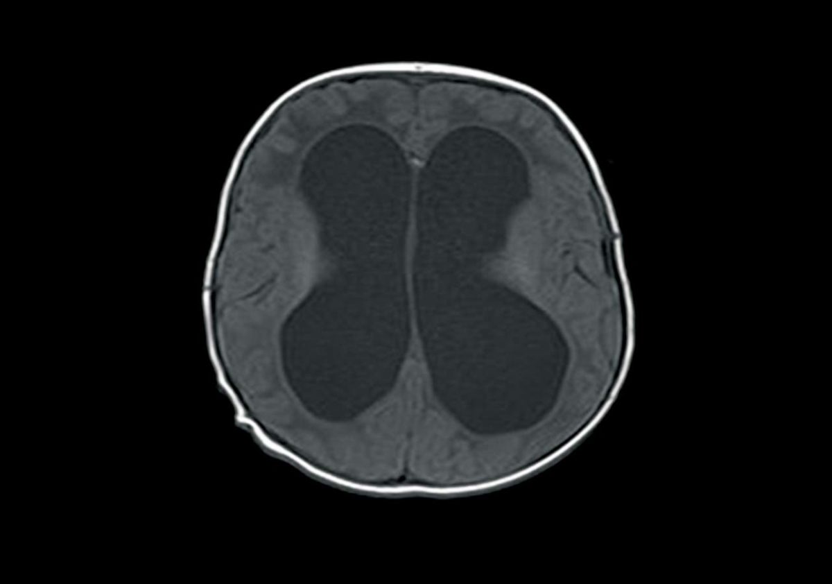 CSF Shunts Neurosurgery Kids Fund