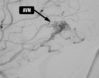 Arteriovenous Malformations - Neurosurgery Kids Fund